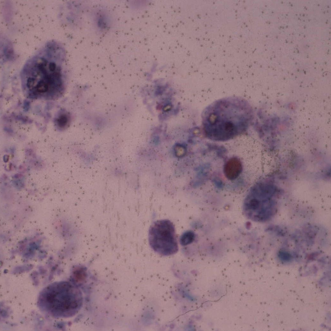 Dientamoeba fragilis a protozoan parasite